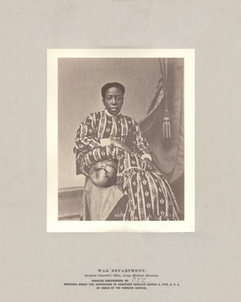 A studio photograph of a seated Black woman. Her skirt is arranged to display her amputated leg.