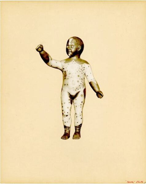 Photographic print of a wax model of a child with a hypopigmentation condition.